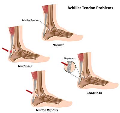 Achilles Tendonitis in Bronxville