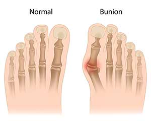 Bunion Surgery Bronxville