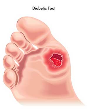 Diabetic Foot Care in Bronxville