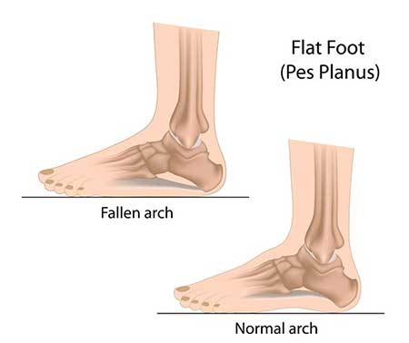 Flat Feet in Bronxville