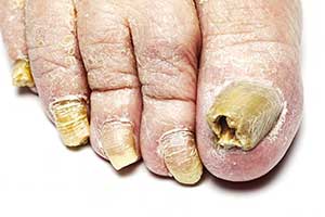 Fungus Nails in Bronxville