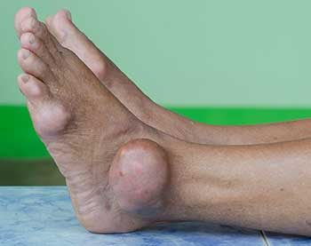 Gout in Bronxville